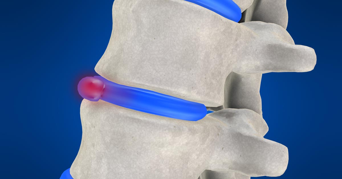 Parkland, FL non-surgical disc herniation treatment